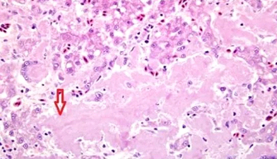 養(yǎng)雞技術(shù) | 雞肝臟腫大出血再認(rèn)識：淀粉樣變